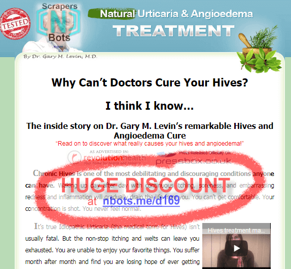 Urticaria Angioedema Natural Treatment System Gary Levin Website.